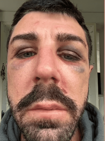 Gay man identified as Aaron was beaten in Sydney by a gang of five thugs (Instagram@aaron)